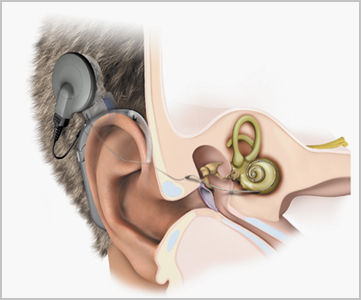 middle-ear