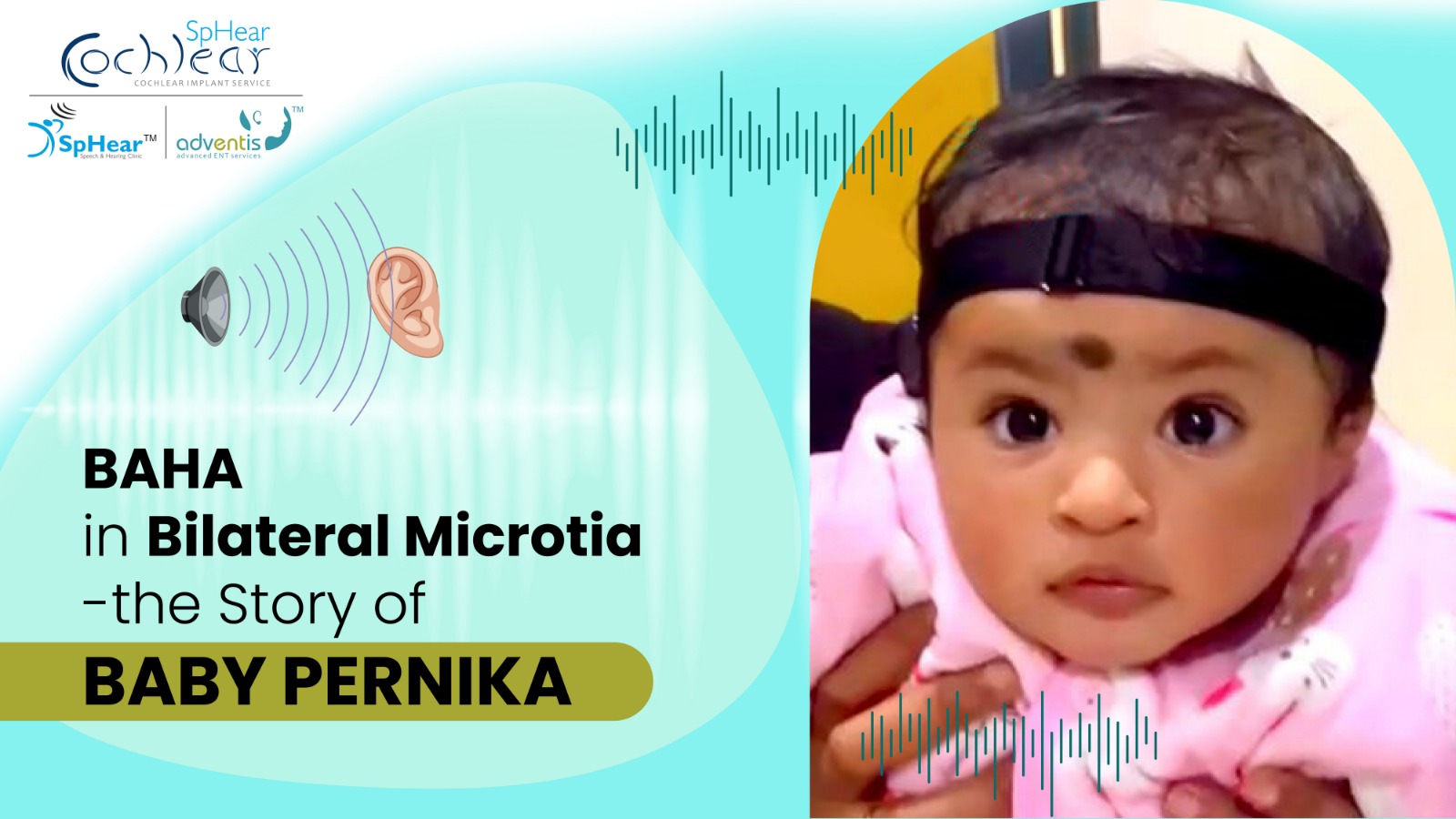 BAHA in Bilateral Microtia - the Story of Baby Pernika