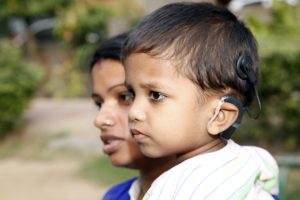cochlear implant